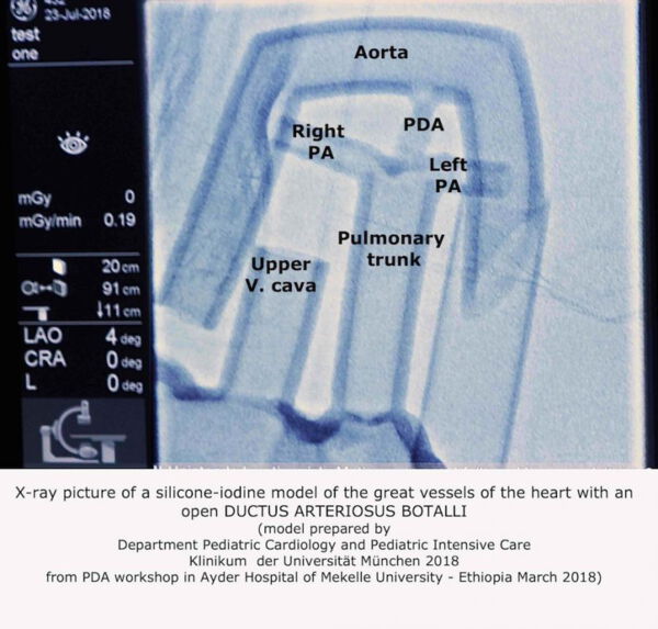 Herz-Simulator für PDA-Verschluss. Erstellt mittels 3D-Drucker aus Silikon und Kontrastmittel